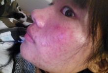 痘痘黑頭侵犯臉上無“顏色”？ 家中常用兩寶，助你除螨祛痘趕黑頭-酷播亮新聞