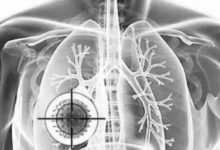 肺癌專家解讀：肺癌可以治癒嗎？—抗癌管家-酷播亮新聞