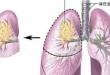 得了肺癌之後 補硒有沒有用-酷播亮新聞
