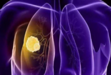 治癒肺癌新希望：靶向藥物之EGFR TKIs及ALK TKIs—抗癌管家-酷播亮新聞