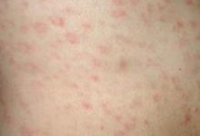 為什麼只有我的皮膚容易過敏，試試這些食療方式-酷播亮新聞