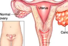 卵巢癌放化療都有哪些副作用反應-酷播亮新聞