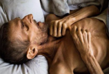 超兩成的腫瘤患者竟是「餓」死的，不吃對飯，哪有力氣抗癌？-酷播亮新聞