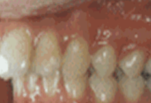 成人牙齒矯正，還值不值得？-酷播亮新聞