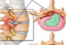 最新！針對腰間盤突出的神奇方法，很多突友受益一生！轉給家人-酷播亮新聞