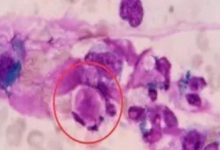 【檢驗臨床面對面】腎病綜合征？狼瘡性腎炎？-酷播亮新聞