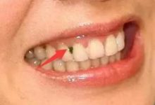 ?吃東西老塞牙，牙縫還很臭？教你1簡單方法，擺脫塞牙口臭問題-酷播亮新聞