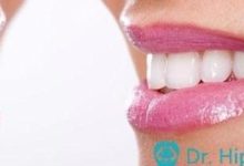 矯正牙齒僅僅是為了漂亮嗎-酷播亮新聞