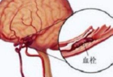 服用阿司匹林預防腦血栓，怎樣服藥更安全有效-酷播亮新聞
