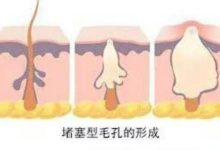 毛孔粗大怎麼辦，怎樣收縮毛孔-酷播亮新聞