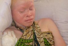 直擊非洲白化病人：常被家人襲擊販賣-酷播亮新聞