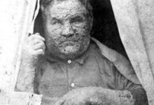 唯一被人類消滅的病毒，天花病毒(屠殺3億人口)-酷播亮新聞