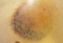 身上總有一堆大大小小的瘀血？教你5個正確方法快速治癒「瘀青」，穿短褲短裙也不害怕啦！-酷播亮新聞