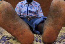 腳底千瘡百孔的非洲人，背後」兇手」令人束手無措！-酷播亮新聞