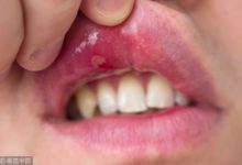 嘴裡總起口腔潰瘍，教你3個方法，簡單快速效果好，學會受用終生-酷播亮新聞