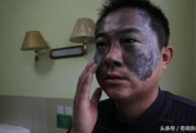 男子欲用激光除胎記，卻慘遭毀容-酷播亮新聞