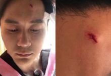 鄧超錄跑男肩膀受傷，李晨額頭縫九針，綜藝節目很嗨，安全須謹慎-酷播亮新聞