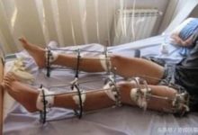 印度的斷骨增高手術十分火爆-酷播亮新聞