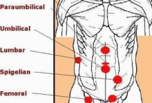 小兒疝氣是怎麼得的 引發原因有多種-酷播亮新聞
