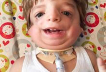 英國寶寶天生面部畸形似毀容-酷播亮新聞