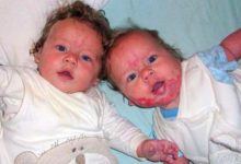 雙胞胎哥哥臉上紅色印記越長越多，導致呼吸困難-酷播亮新聞