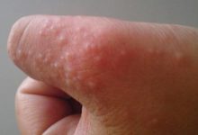 手腳長小水泡奇癢難忍？教你一招，輕鬆去除水泡，簡單效果好-酷播亮新聞