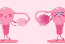 卵巢癌的四大高危因素-酷播亮新聞