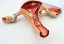 子宮被切除後，會引起高血壓嗎？-酷播亮新聞