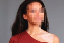 如何預防女性臉部白癜風的擴散-酷播亮新聞