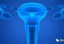 卵巢腫瘤指標Ca125升高，代表啥？-酷播亮新聞