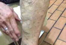 【每日分享】尚赫TBS—靜脈曲張調理手法教程及案例分享-酷播亮新聞