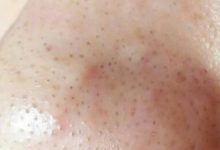 鼻子黑頭多，是蟎蟲排泄物太多，除蟎3招，黑頭不再長-酷播亮新聞