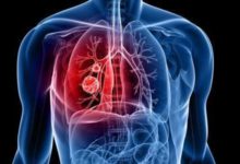 17種抗癌藥納入醫保 女性為什麼更容易得肺癌-酷播亮新聞