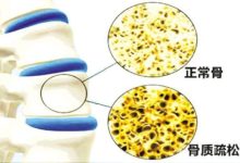 七旬老太抬手穿衣突發骨折，專家提醒：絕經後女性千萬當心-酷播亮新聞