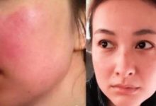 神奇的「痘痘橡皮擦」，幫助600萬人徹底告別痘痘，諾貝爾獎新技術，藥效增強500倍！-酷播亮新聞