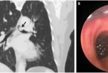 NEJM：支氣管黑色素瘤-病例報道-酷播亮新聞