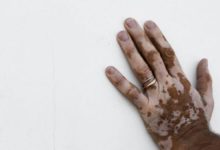 如何治療女性的白癜風才正確-酷播亮新聞