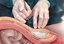 剖腹產後的3大「後遺症」，特別是第二種，作為女性你應該了解！-酷播亮新聞