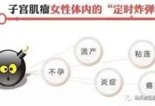 道虎壁王氏女科，中醫治療子宮肌瘤、卵巢囊腫，最怕惡變！-酷播亮新聞