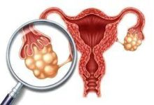 「搬開」造成多囊卵巢的三座大山——肥胖、胰島素抵抗和高雄激素-酷播亮新聞