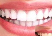 冷光美白一周后變黃了什麼原因-酷播亮新聞