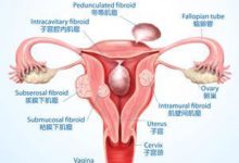 子宮肌瘤割掉好與不好? 陳向榮主任：「誰割誰後悔」-酷播亮新聞